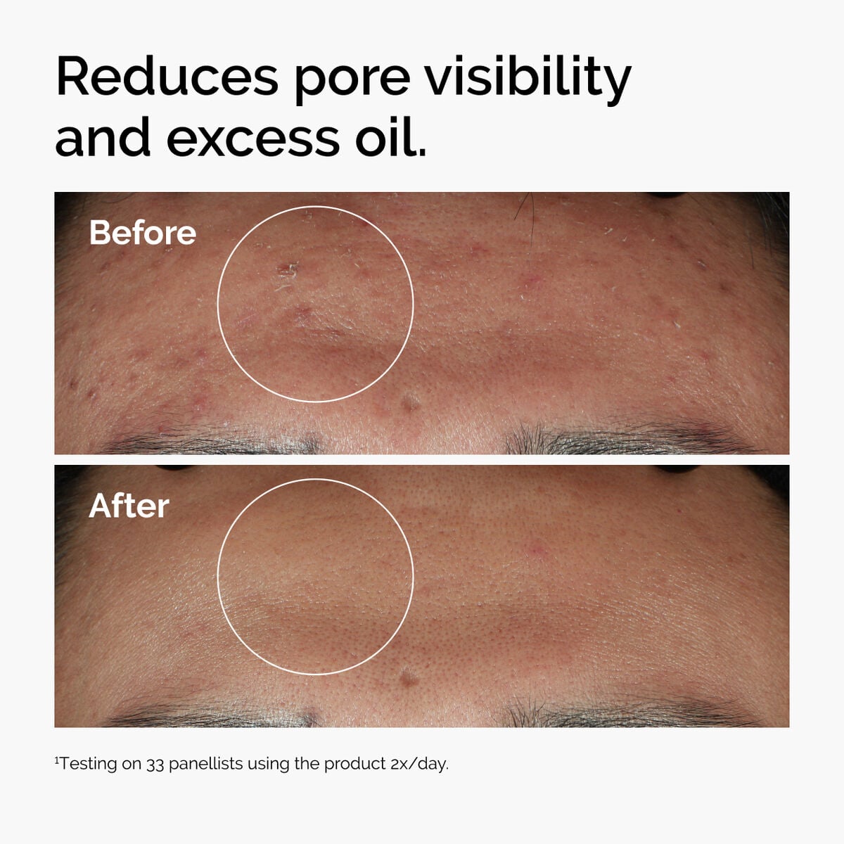 niacinamide-10-zinc-1-l1 ord-niacinamide-zinc-blemish-serum-before-after-pores.jpg