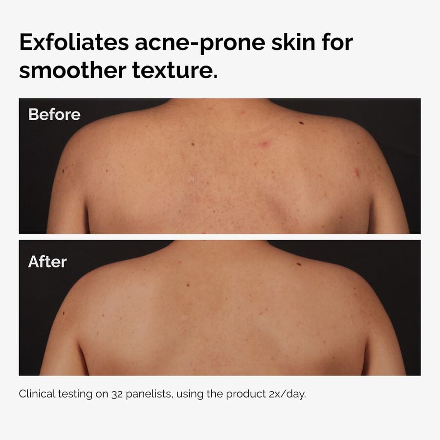 the-body-care-collection-z4 ord-salicylic-acid-body-serum-before-after-graphic-NA.jpg