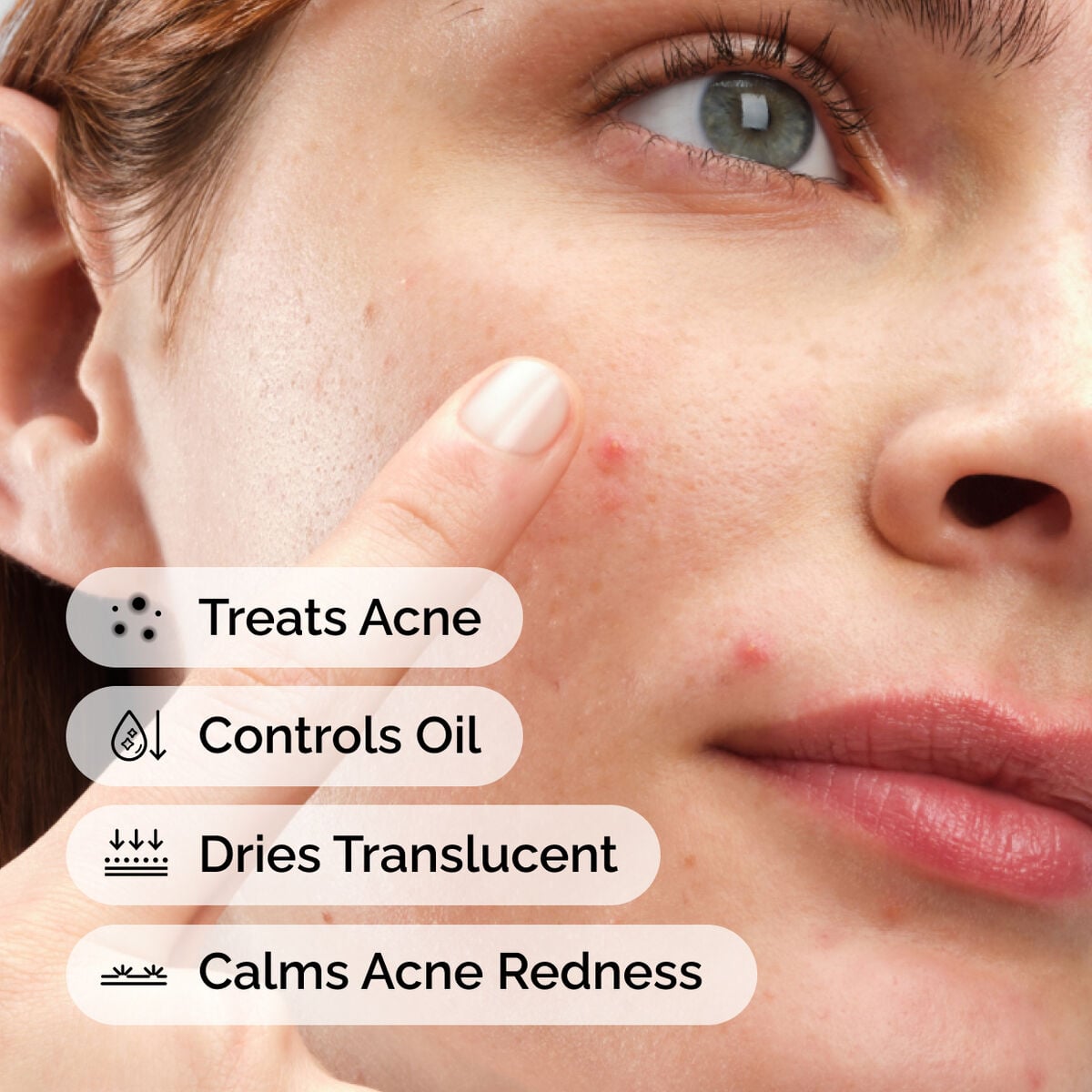 sulfur-10-powder-to-cream-concentrate-z1 ord-sulfur-10pct-powder-to-cream-concentrate-model-application-with-benefits-acne.jpg