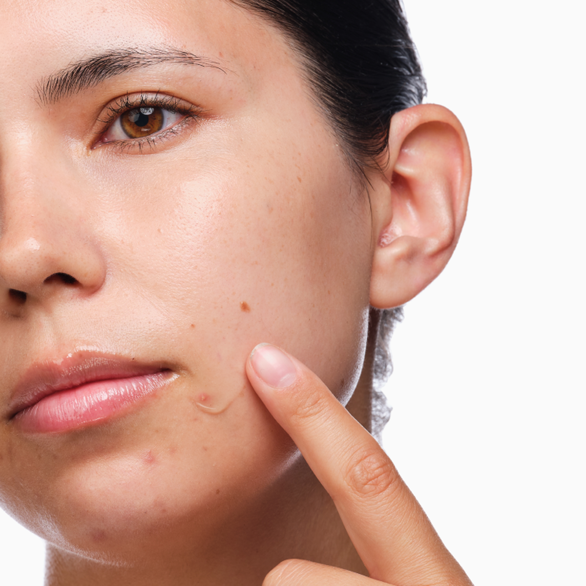 the-acne-set-u8 rdn-the-acne-set-application.png